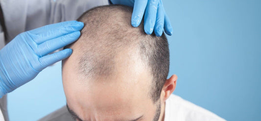 IS A HAIR TRANSPLANTATION PERMANENT OPERATION IN 2023?